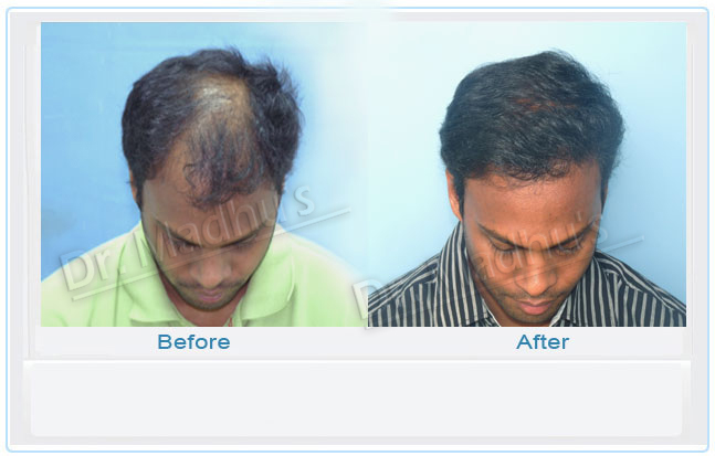 Dr Madhu Hair Transplant Images