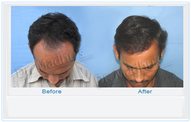 Hair Transplant in Hyderabad India - Dr. Madhu 's Advanced Hair Transplant  Center