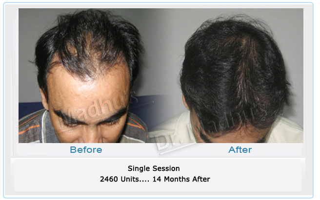 Hair Transplant in Hyderabad India - Dr. Madhu 's Advanced Hair Transplant  Center