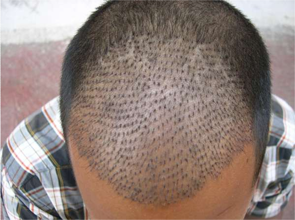 :::Hair Transplant Surgeon, India- Hyderabad::: for best Quality &  Results::: to educate about advise for Hairloss