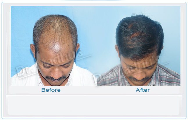 images-hair-transplant