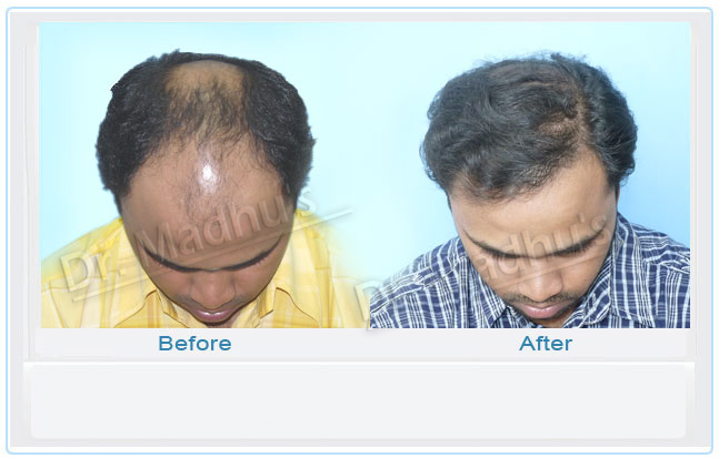 images-hair-transplant