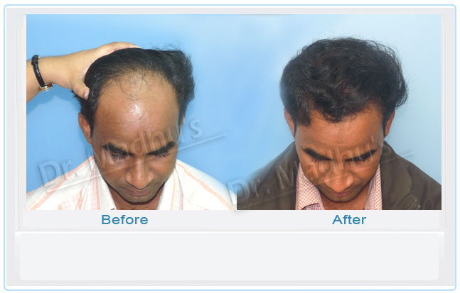 images-hair-transplant