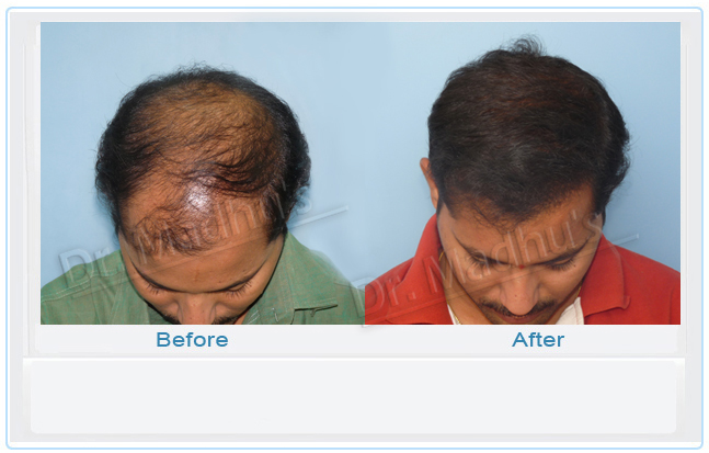 images-hair-transplant