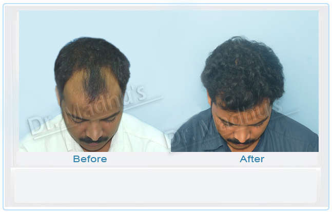 images-hair-transplant