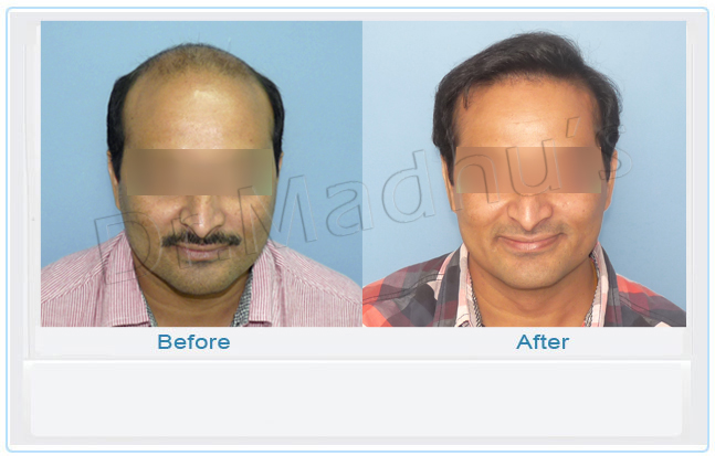 images-hair-transplant