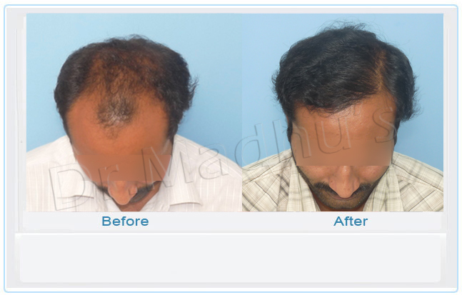 images-hair-transplant