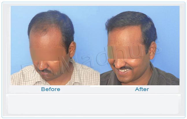 images-hair-transplant