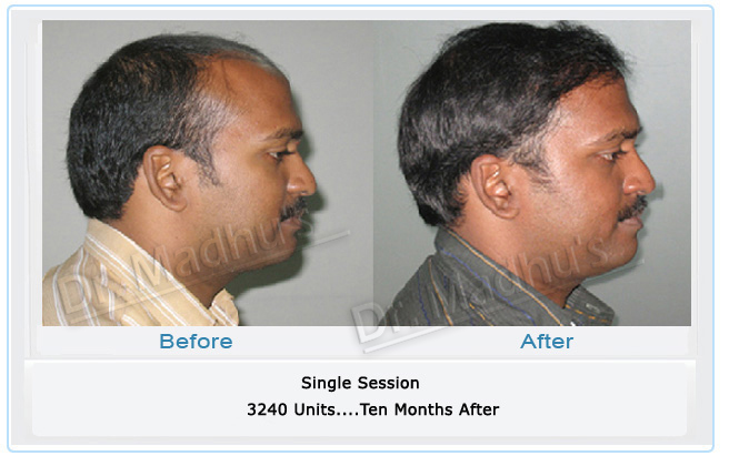 images-hair-transplant-mumbai