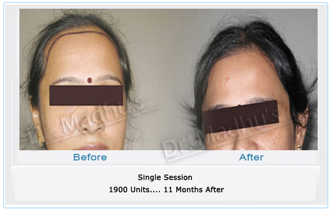 woman-hair-loss-treatment