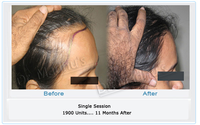 images-hair-transplant-treament