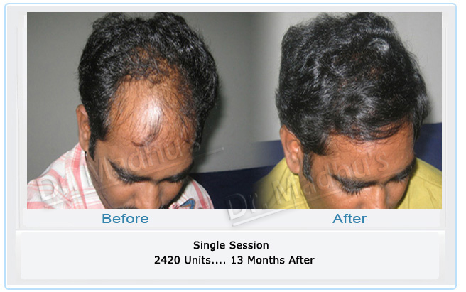 images-hair-transplant-delhi