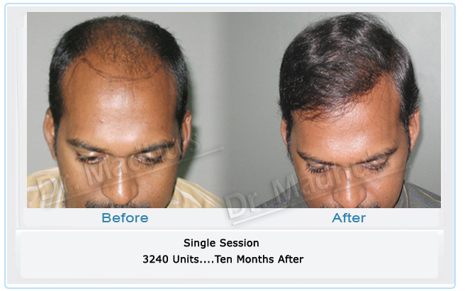 images-hair-transplant-mumbai
