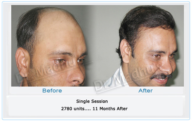 images-hair-transplant-chennai