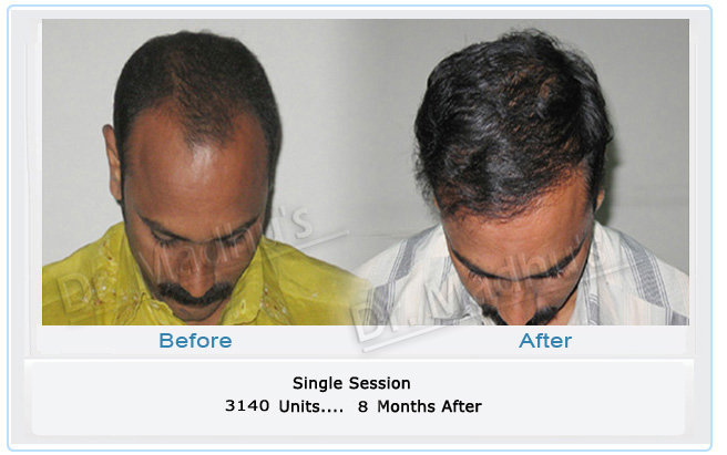 images-hair-transplant-bangalore