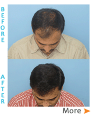 Best FUE Hair Transplant in Hyderabad | Dr. Y V Rao Clinics